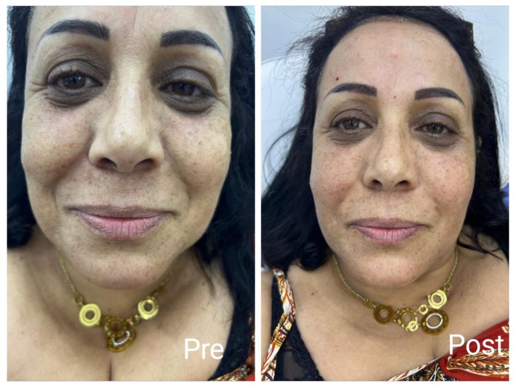 Face filler before and after